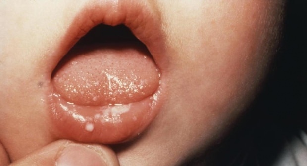 Kako boli usta kod beba