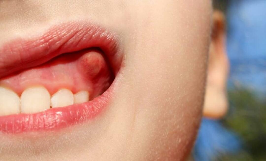 Zašto dolazi do apscesa zuba i koji su simptomi? Zubni apsces, kako se liječi?
