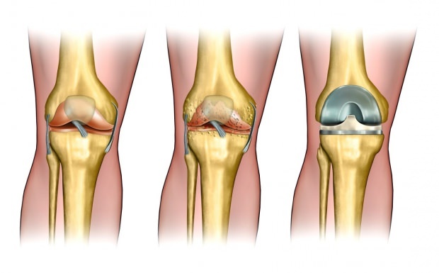 Bolesti poput artritisa dovode do olakšavanja boli