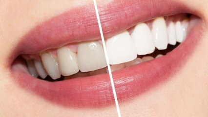 Koje su preporuke za bijele zube? Izbjeljivanje zuba prirodno liječi kod kuće ...