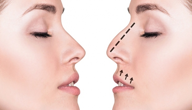 Kako se radi operacija nosa? U kojim se slučajevima obavlja operacija rinoplastike?
