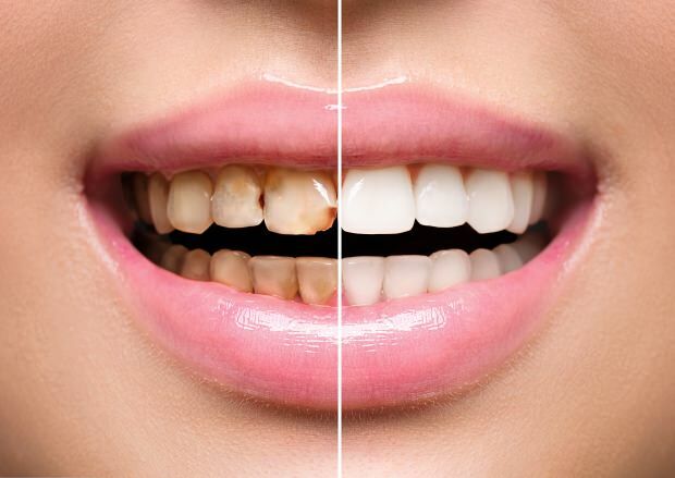 Kao rezultat nezdrave prehrane dolazi do promjene boje kože i gubitka zuba
