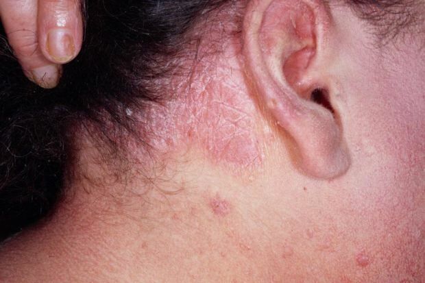 Koji su simptomi seboroičnog dermatitisa i kod koga se pojavljuje? Hrana koja pokreće bolest