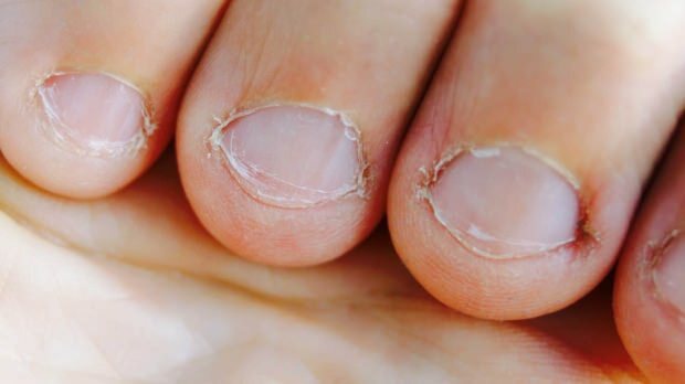 Što je bolest jedenja noktiju? Koje bolesti uzrokuje jedenje noktiju?