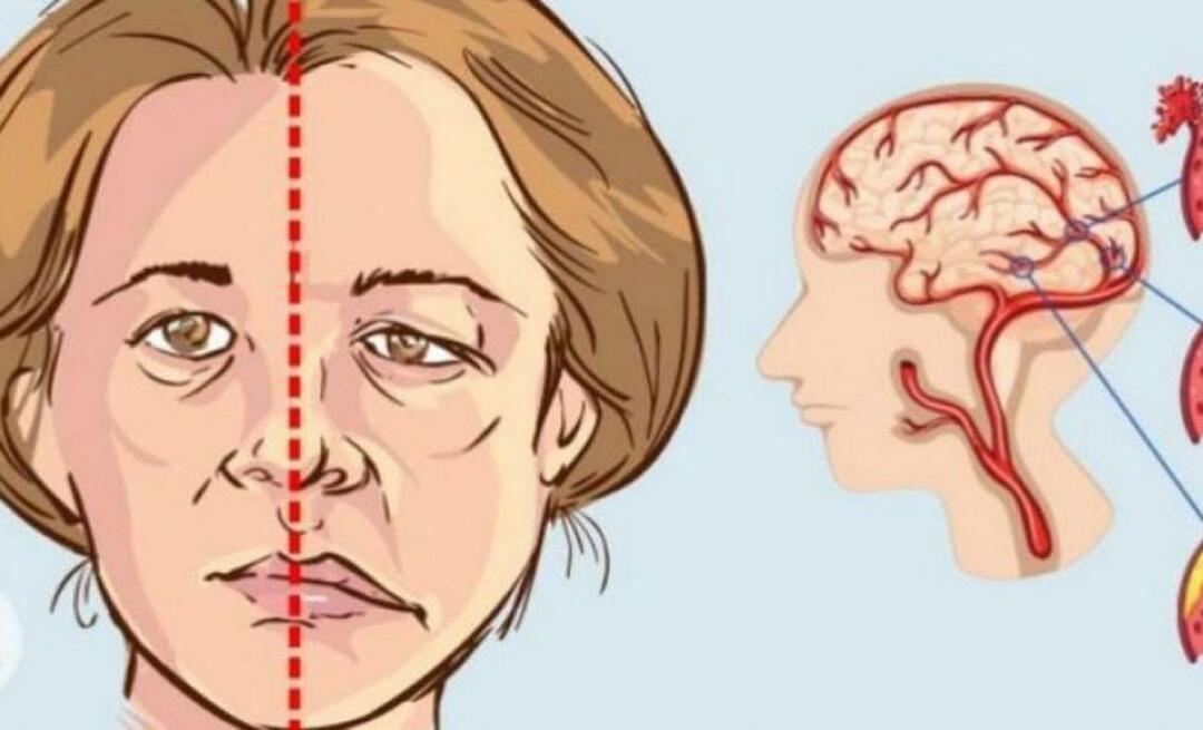 Što je moždani udar? Koji su simptomi moždanog udara? Kako spriječiti moždani udar?