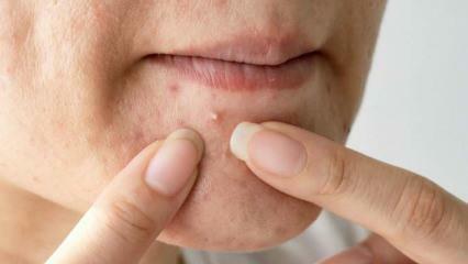 Zašto se akne pojavljuju na bradi? Prirodno rješenje za akne na bradi