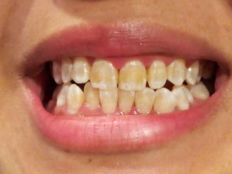 slika zuba osobe čiji zubi počinju potamniti