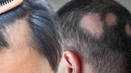 Što je lišajevi (Alopecia areata)? Što su simptomi lišajevi? Učinkovita rješenja za ringworm