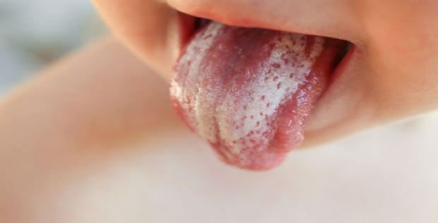 Oralno liječenje gljivica u dojenčadi