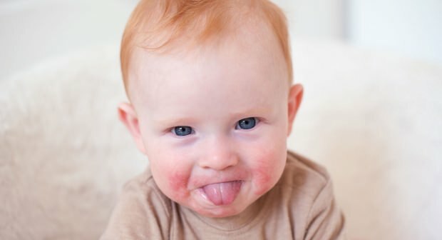 Pažnja kod beba s crvenim obrazima! Sindrom slomljenog obraza i njegovi simptomi