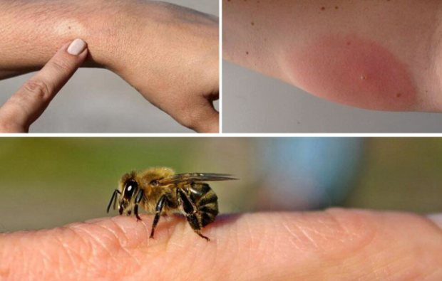 simptomi alergije na pčele