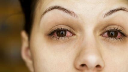 Što je konjuktivitis (očna gripa) i koji su njegovi simptomi? Kako se prenosi konjuktivitis?