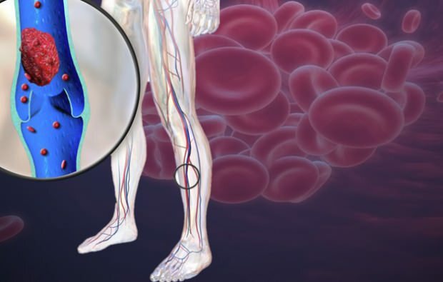 smanjena cirkulacija krvi u venama nogu uzrokuje bol